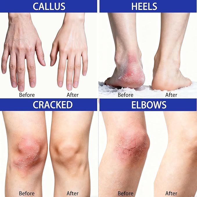 40% Urea Foot Cream with 2% Salicylic Acid, Urea Cream 40 Percent for Feet & Hands-Maximum Strength Moisturizer for Rough, Dry, Thick & Cracked Skin, Deep Hydration, Non-Greasy, 5.29 oz