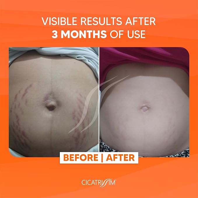 Cicatrissim Stretch Mark Cream for Red and White Striae - Softens Stretch Marks, Evens Skin Tone, and Firms Skin - All Skin Types - 150g