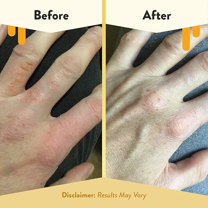 ECZEMA HONEY Oatmeal Hand Cream - Natural Hand & Body Lotion for Eczema Rash Relief - Eczema Cream for Dry, Itchy, Sensitive, & Irritable Skin (4 Oz)