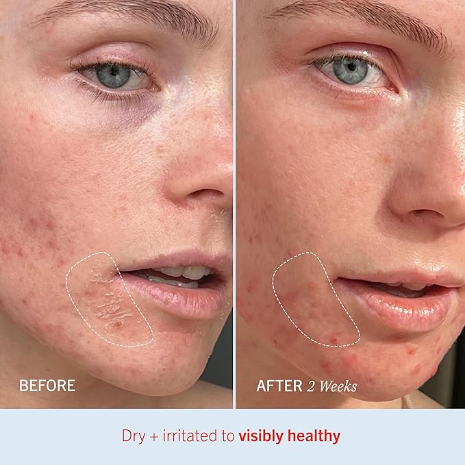 First Aid Beauty - Ultra Repair Cream, Intense Hydration Whipped Colloidal Oatmeal, Clinically Proven to Strengthen Skin Barrier in 7 Days & Helps Relieve Eczema, Luxury Face & Body Moisturizer, 14 oz
